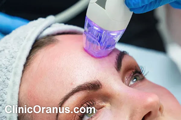 مزایای انجام آر اف فرکشنال | کلینیک اورانوس